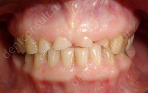 6 причин патологической стираемости зубов + лечение