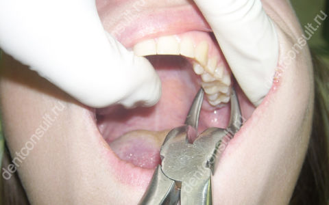 Где удалять зубы проще и безопаснее – на верхней или нижней челюсти? Рассматриваем особенности процедуры