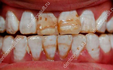 Зубы Фурнье (системная гипоплазия) – особенности развития патология и методы лечения