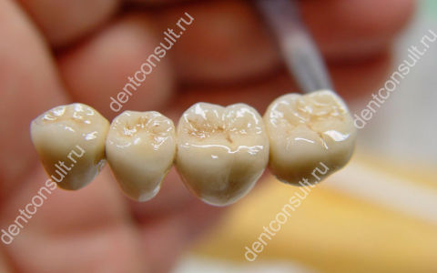 Можно ли отбелить металлокерамические зубы и зубы с пломбами