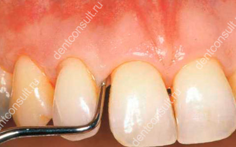 Карман в десне между зубами — как лечить