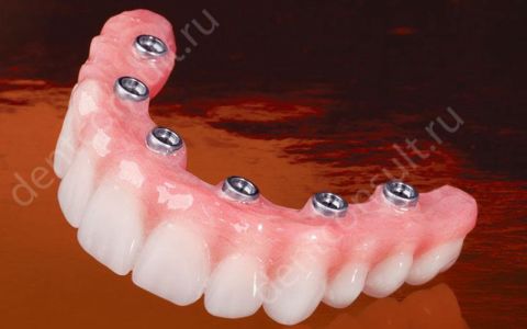 Съемные зубные протезы на имплантах