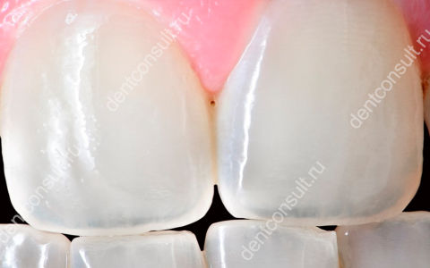 Почему зубы становятся прозрачными, методы восстановления