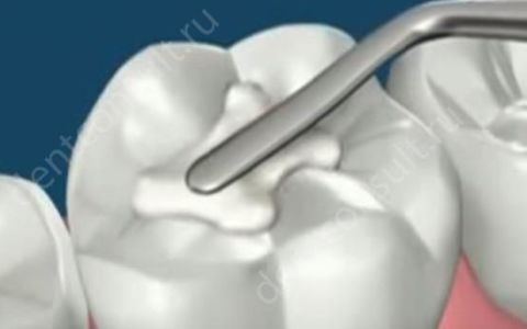 Обзор лучших популярных зубных пломб и их сравнение!