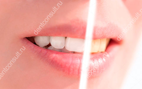 Кислородное отбеливание зубов