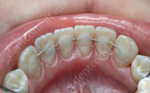 Показания к шинированию зубов: виды, фото до и после