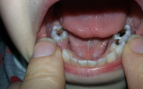 Пульпит молочных зубов, методы лечения