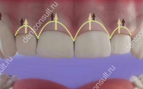 Удлинение зубов – зачем нужно