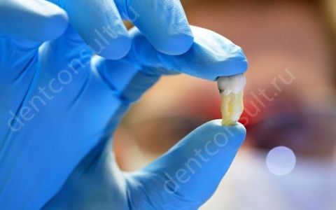 Показания и противопоказания к удалению зуба