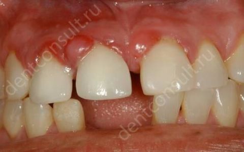 Что такое гранулирующий периодонтит или гранулема зуба – симптомы и лечение