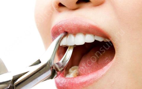 Альвеолит после удаления зуба
