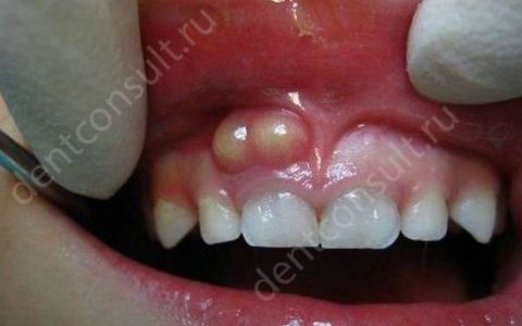 Что такое флюс зуба, какие симптомы заболевания и как его лечить?
