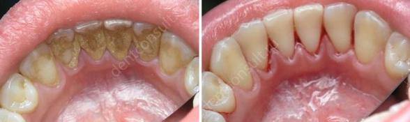 до и после чистки зубов с внутренней стороны