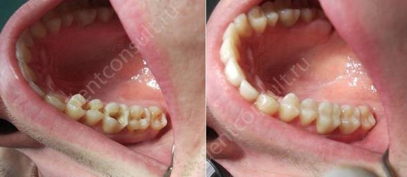реставрация зубов до и после