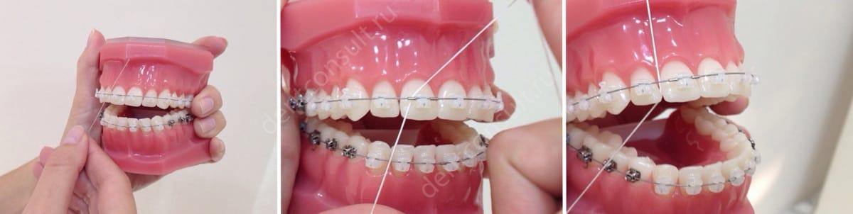Использование зубной нити