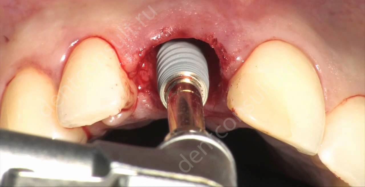 Какие зубы лучше вставить, протезирование или имплантация?