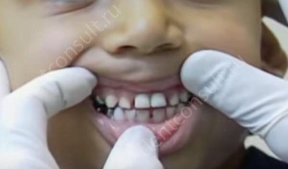 коронки на молочные зубы