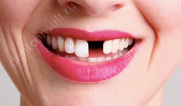 Какие зубы лучше вставить, протезирование или имплантация?