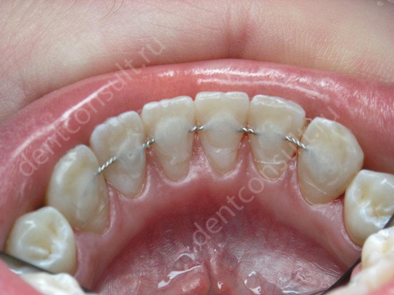 Показания к шинированию зубов: виды, фото до и после