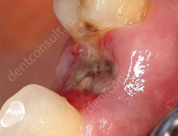 На фото показано воспаление лунки после удаления зуба