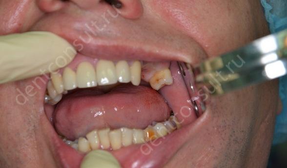 На фото показано отсутствие зуба на верхней челюсти