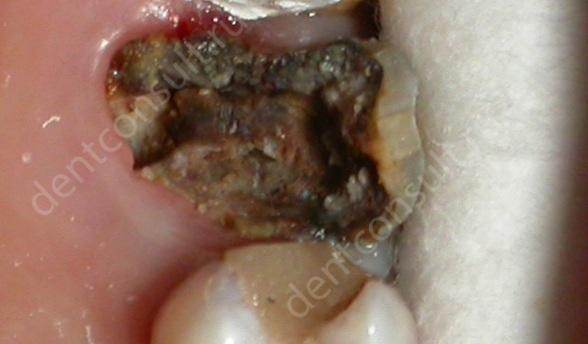 На фото показан поврежденный зуб, который подлежит удалению