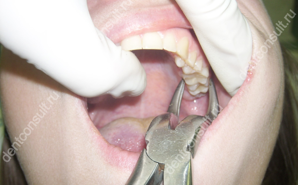 Где удалять зубы проще и безопаснее – на верхней или нижней челюсти? Рассматриваем особенности процедуры