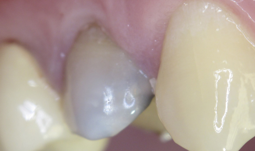 Потемневший зуб - как следствие использования мышьяка