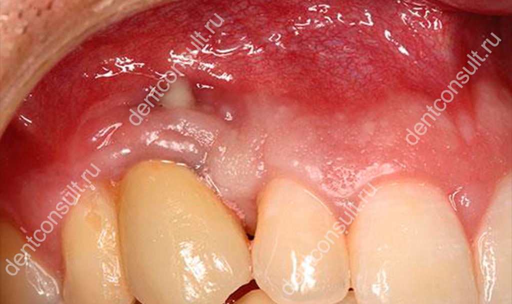 Гноится десна около зуба (опухла и болит) – что делать и как лечить