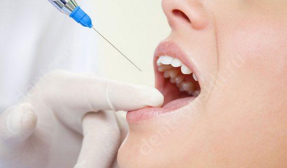 обезболивание при лечении зубов