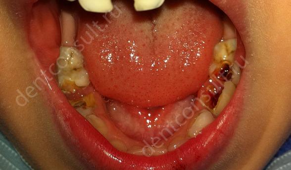 Острый и хронический пульпит: лечить или удалять зуб?