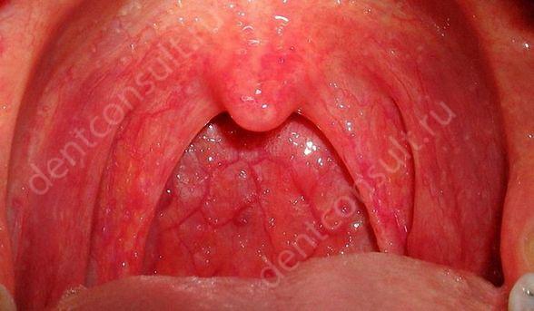 воспаленная слизистая рта