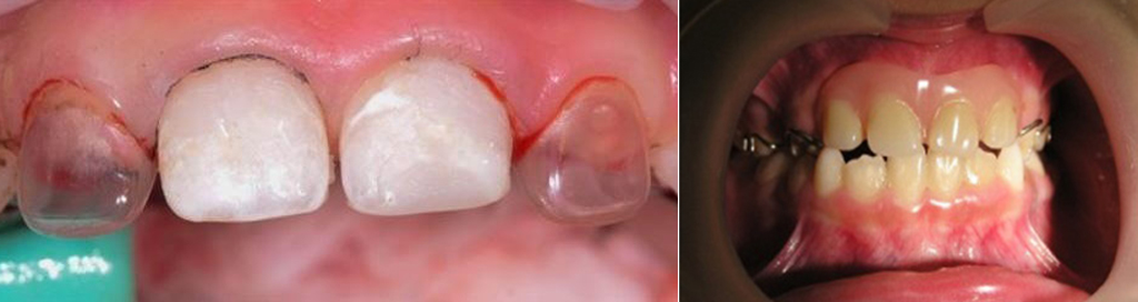 Так выглядит протезирование молочных зубов