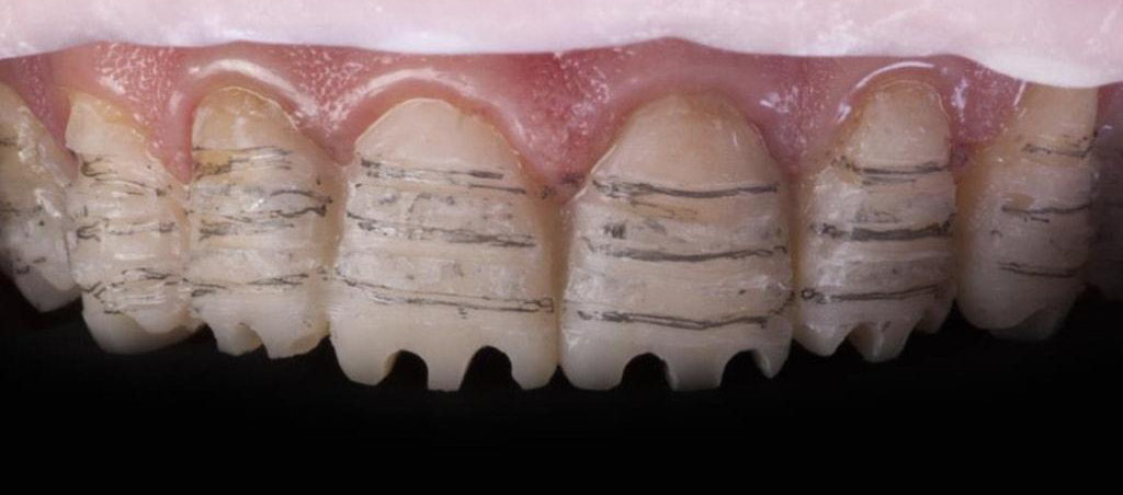 На фото показаны зубы сточенные под виниры