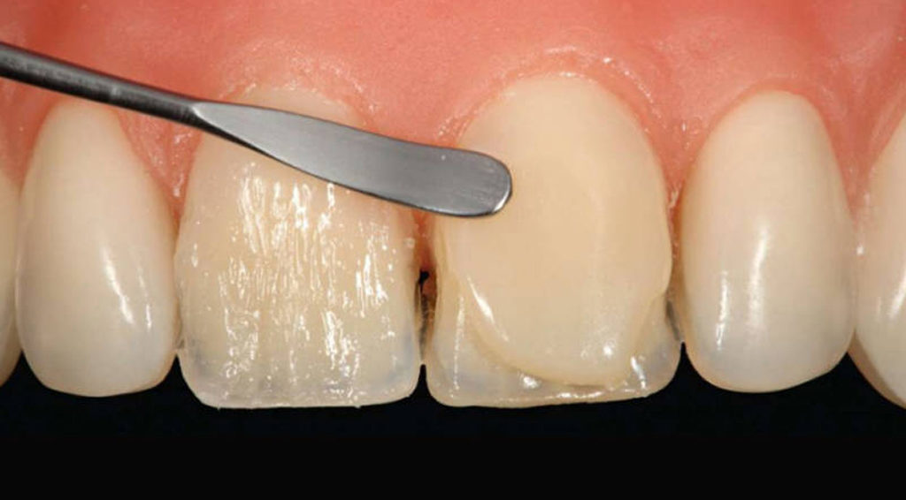 Так происходит композитная реставрация зубов