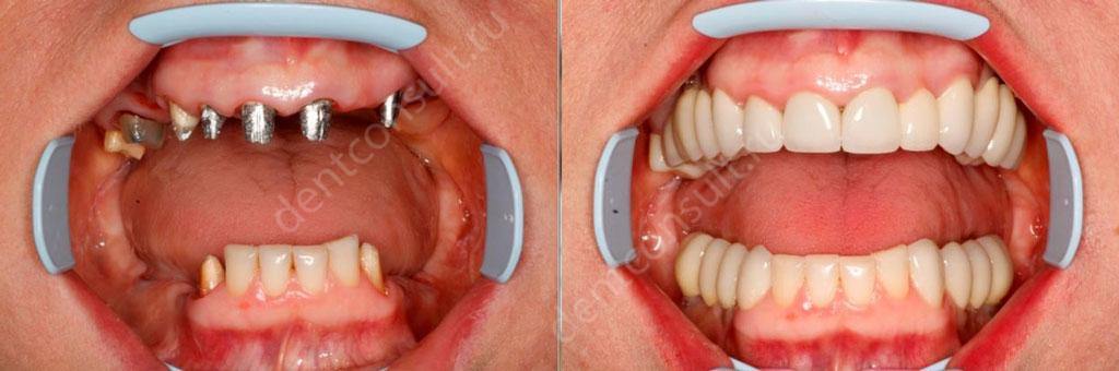 Имплантация зубов до и после