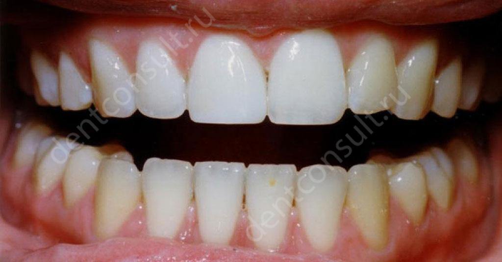 передние зубы