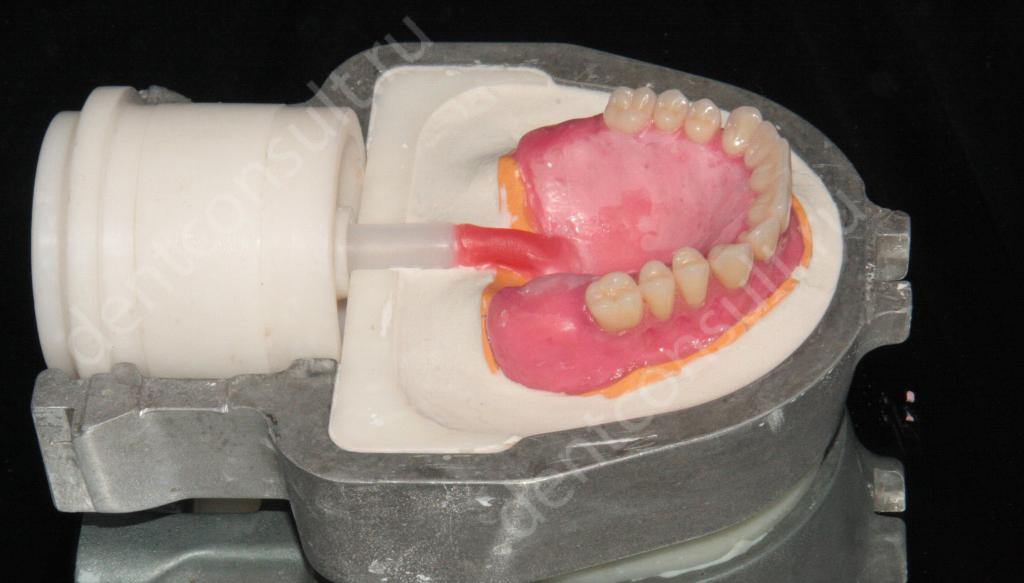 Установка зубных протезов при полном отсутствии зубов