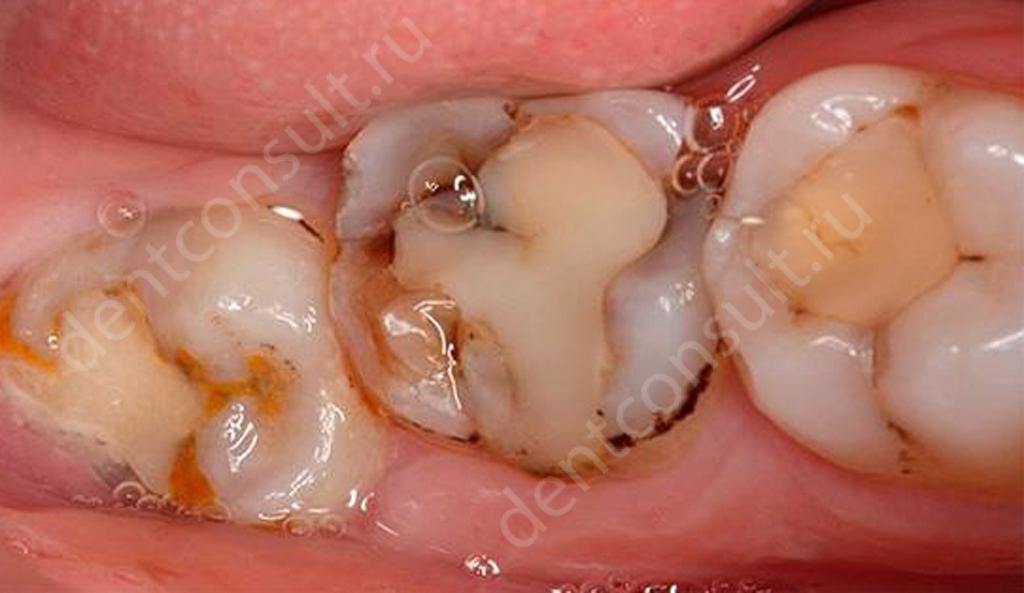 разрушение зубов под пломбами