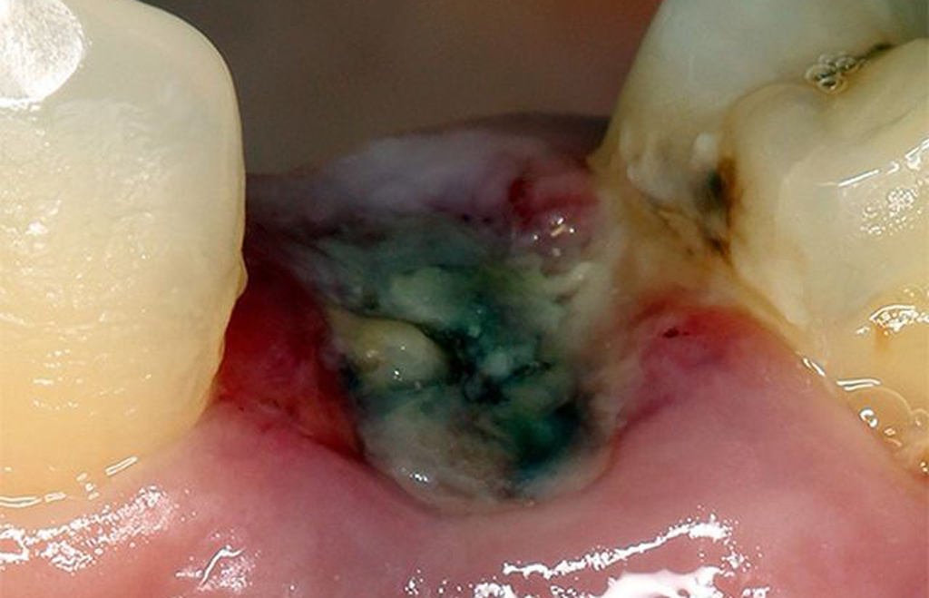 Что происходит с десной после удаления зуба