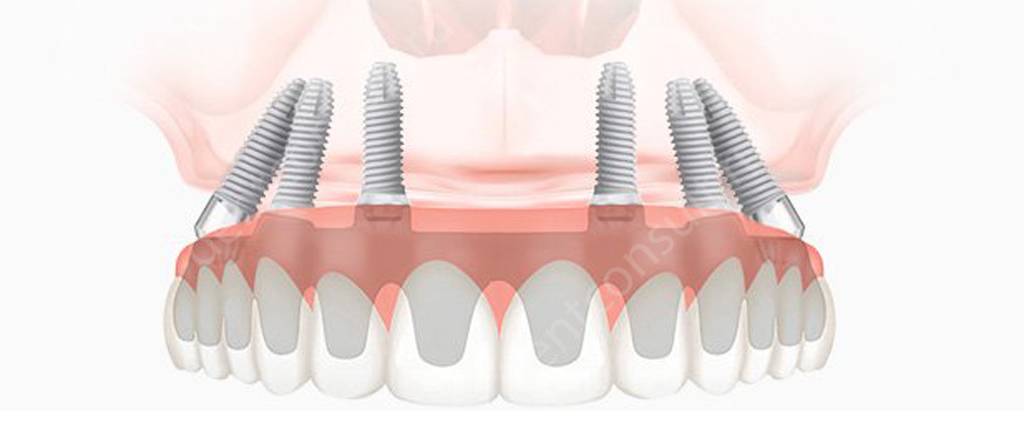 Имплантация зубов All-an-6