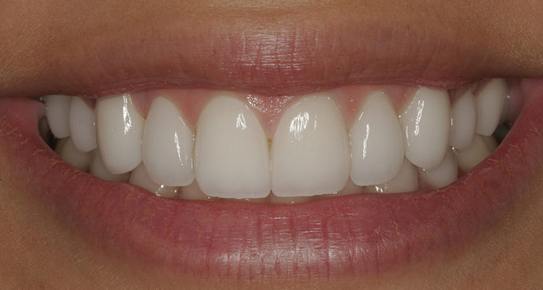Фото зубов из циркония и металлокерамики в сравнении
