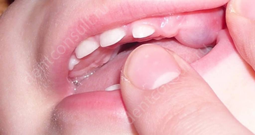 Образование бугорка на десне при прорезывании зубов