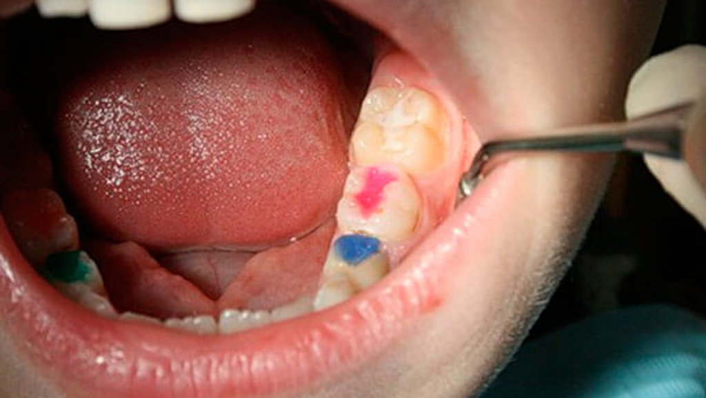 Цветные пломбы украсят зубы детей