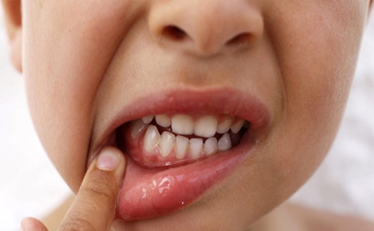Стоматит у ребенка во рту на языке фото