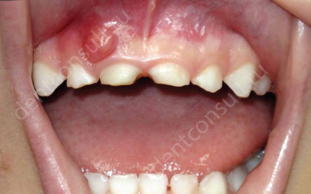 На фото – киста зуба у ребенка