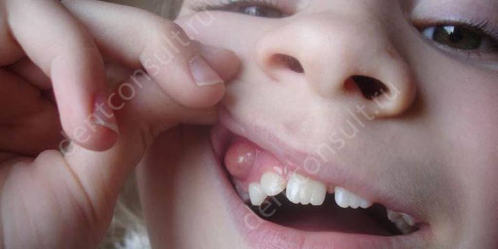 Киста зуба у ребенка