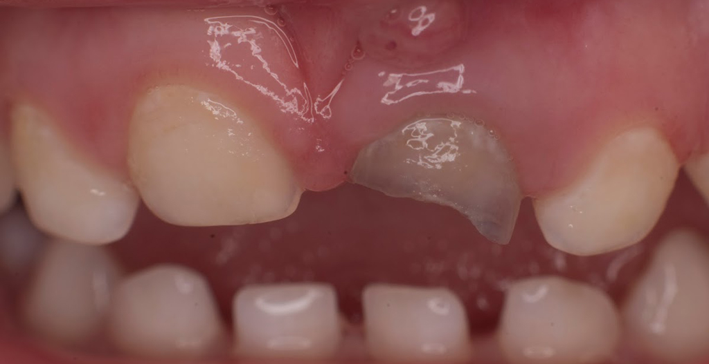 Пульпит или периодонтит - показание к удалению молочного зуба