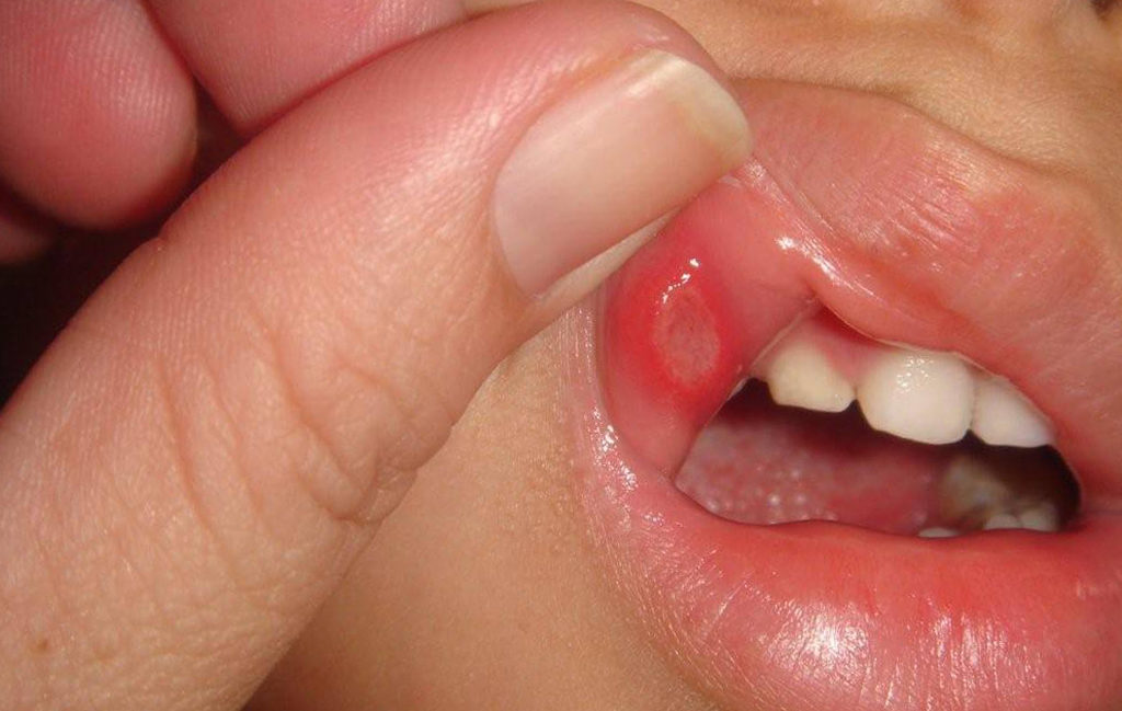 Афтоз на слизистой оболочке во рту у ребенка