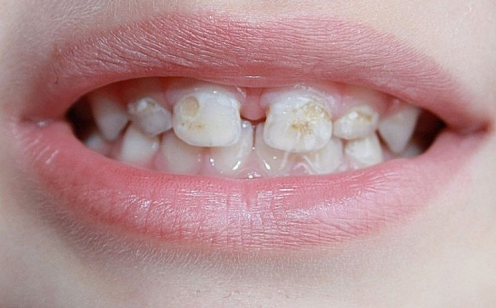 Гипоплазия зубов у ребенка
